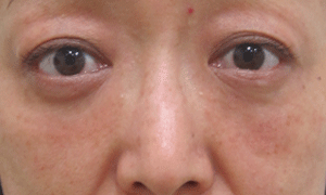 目の下のたるみ手術１か月後